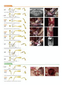 ultrasurgery6 ultrasurgery6 woodpecker ultra surgery